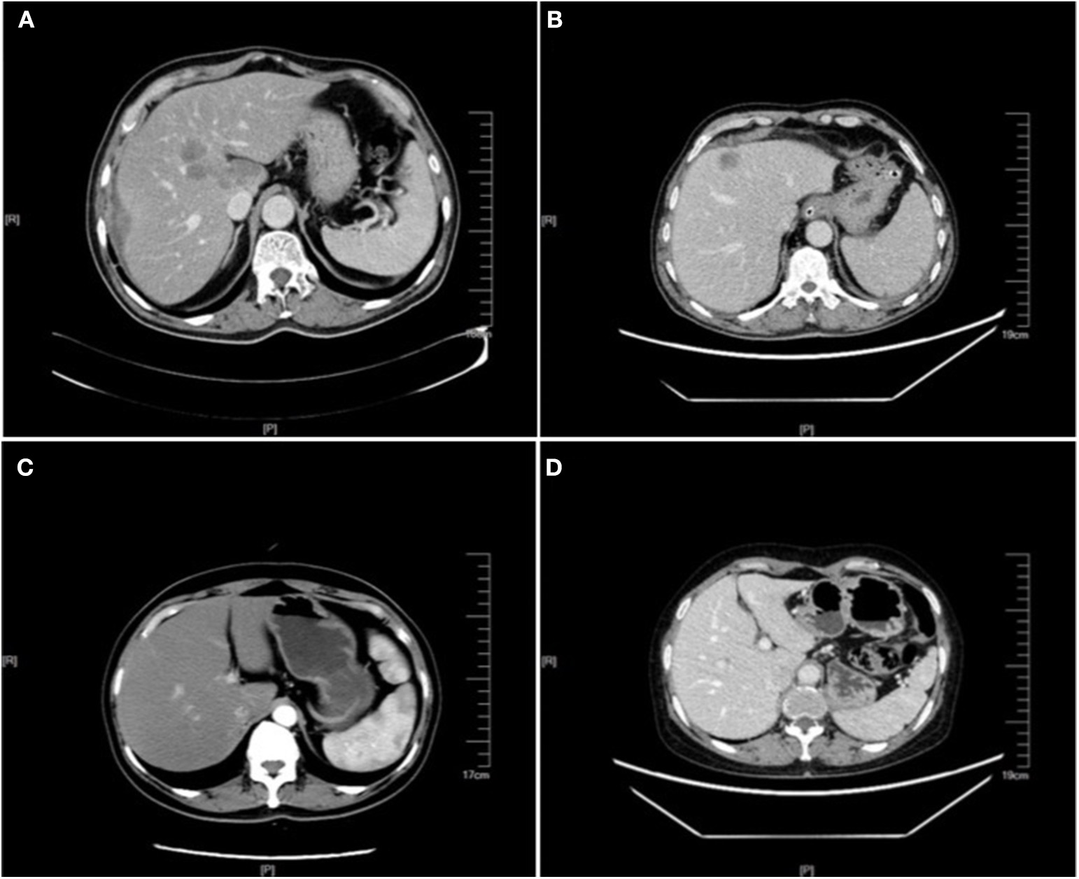 Enhanced CT images of colorectal cancer liver metastasis with comparator liver images