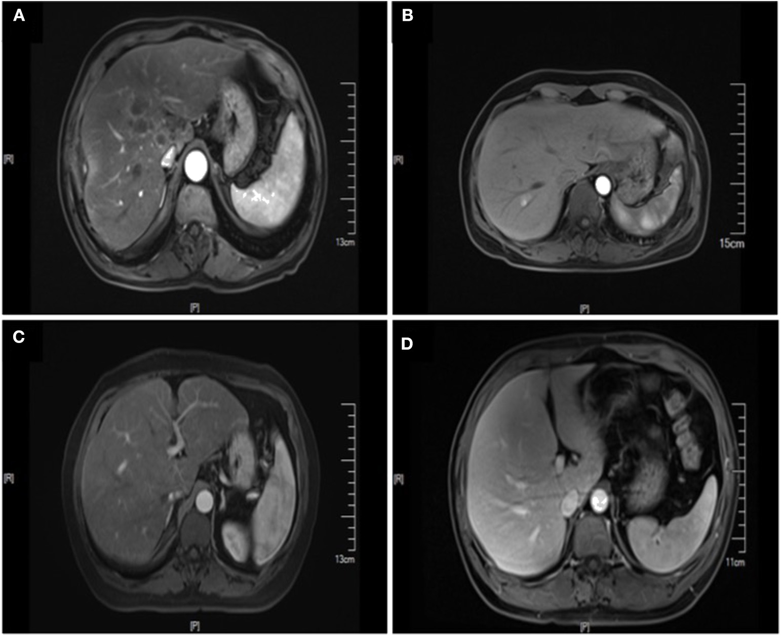 Enhanced MRI images of colorectal cancer liver metastasis with comparator liver images