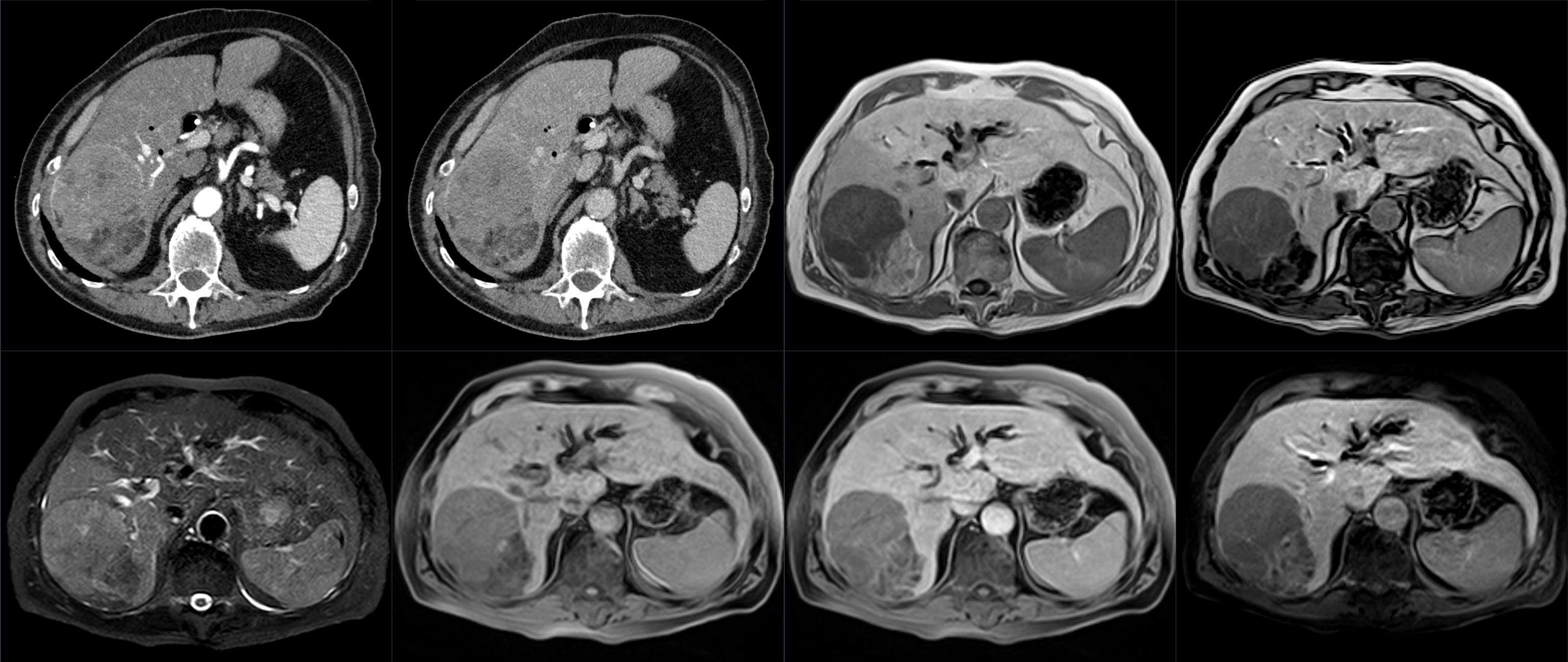 Hepatocellular carcinoma CT and MRI panel showing arterial, portal venous, T1, T2, and delayed-phase images