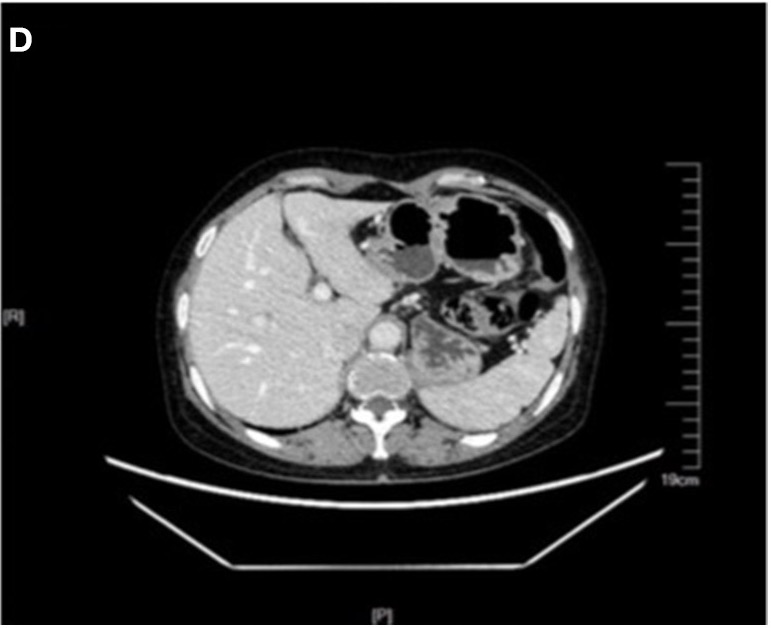 Normal liver CT comparator from a colorectal cancer imaging figure
